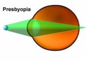 Пресбиопия.